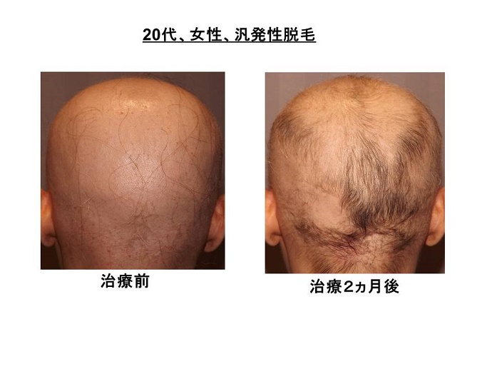 円形脱毛症　病院""